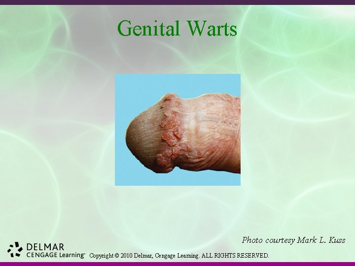 Genital Warts Photo courtesy Mark L. Kuss Copyright © 2010 Delmar, Cengage Learning. ALL
