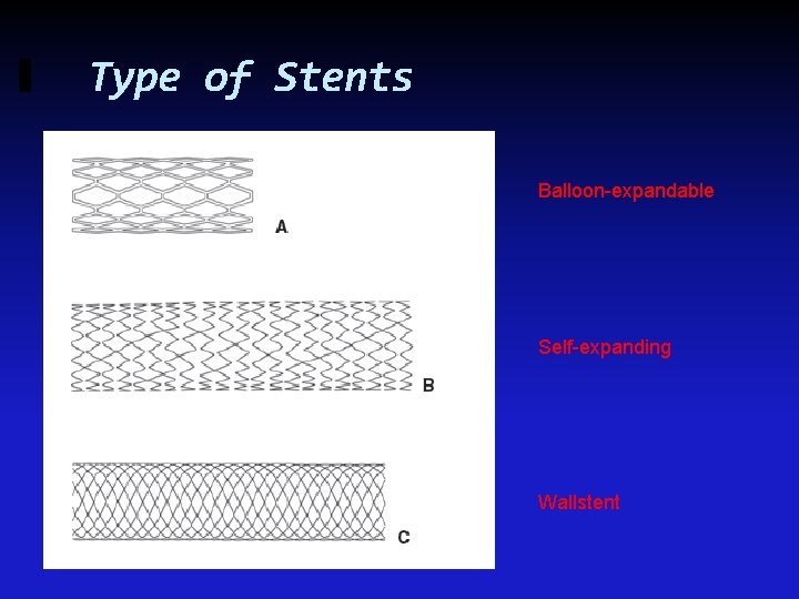 Type of Stents Balloon-expandable Self-expanding Wallstent 