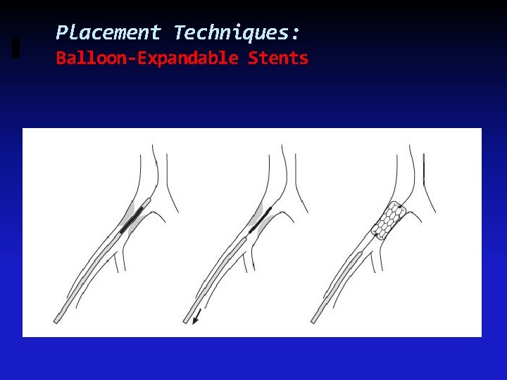 Placement Techniques: Balloon-Expandable Stents 