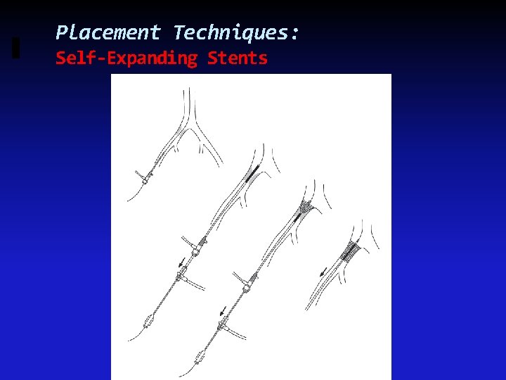 Placement Techniques: Self-Expanding Stents 