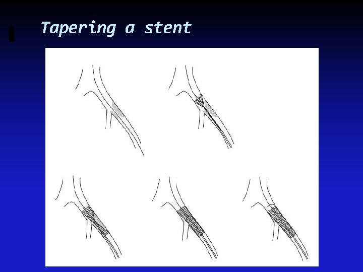 Tapering a stent 