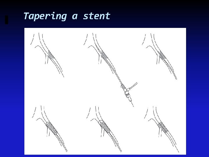 Tapering a stent 