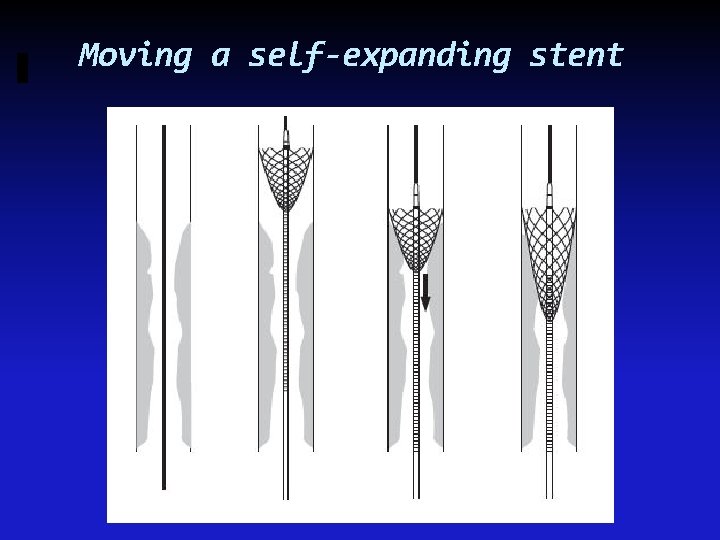 Moving a self-expanding stent 