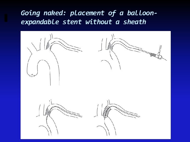 Going naked: placement of a balloonexpandable stent without a sheath 