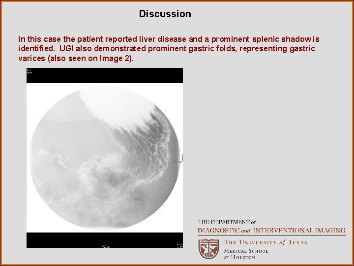 Discussion In this case the patient reported liver disease and a prominent splenic shadow