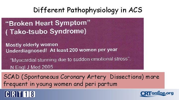 Different Pathophysiology in ACS SCAD (Spontaneous Coronary Artery Dissections) more frequent in young women