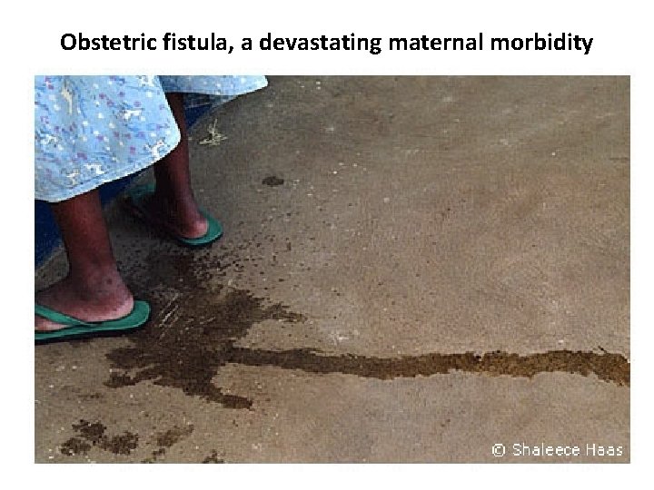 Obstetric fistula, a devastating maternal morbidity 