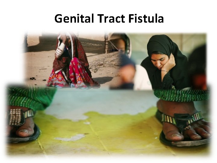 Genital Tract Fistula 
