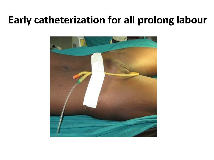 Early catheterization for all prolong labour 