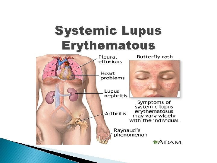 Systemic Lupus Erythematous 