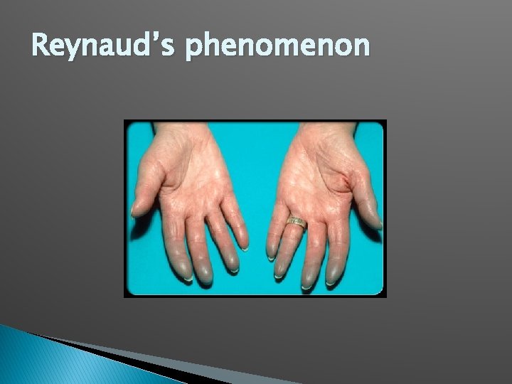 Reynaud’s phenomenon 