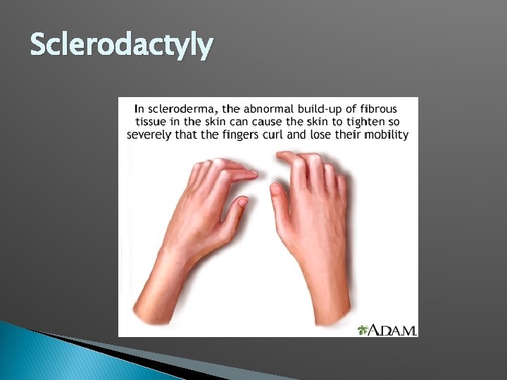 Sclerodactyly 