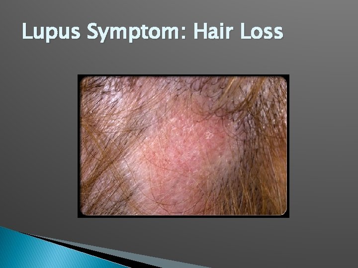 Lupus Symptom: Hair Loss 