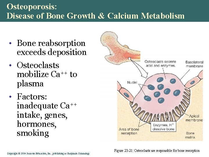 Osteoporosis: Disease of Bone Growth & Calcium Metabolism • Bone reabsorption exceeds deposition •
