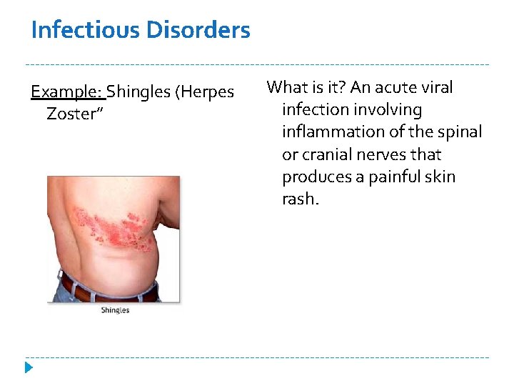 Infectious Disorders Example: Shingles (Herpes Zoster” What is it? An acute viral infection involving