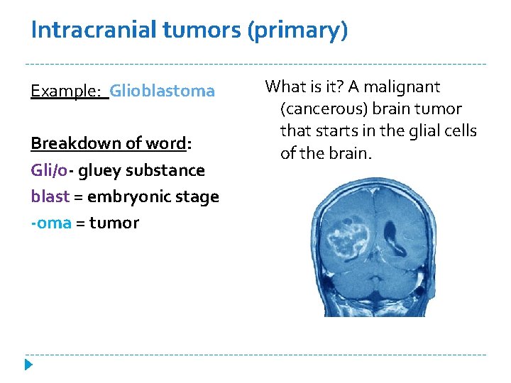 Intracranial tumors (primary) Example: Glioblastoma Breakdown of word: Gli/o- gluey substance blast = embryonic