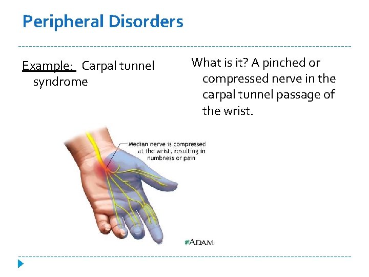Peripheral Disorders Example: Carpal tunnel syndrome What is it? A pinched or compressed nerve