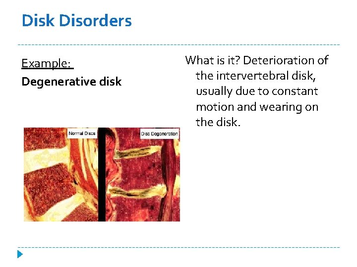 Disk Disorders Example: Degenerative disk What is it? Deterioration of the intervertebral disk, usually