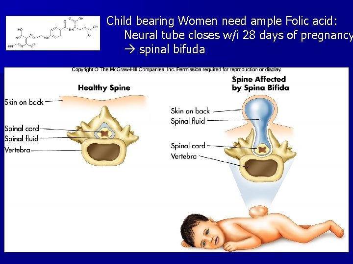 Child bearing Women need ample Folic acid: Neural tube closes w/i 28 days of