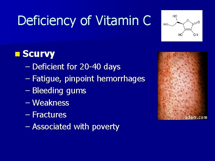 Deficiency of Vitamin C n Scurvy – Deficient for 20 -40 days – Fatigue,
