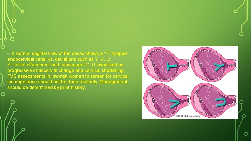 -- A normal sagittal view of the cervix shows a “T” shaped endocervical canal