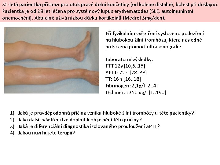 35 -letá pacientka přichází pro otok pravé dolní končetiny (od kolene distálně, bolest při