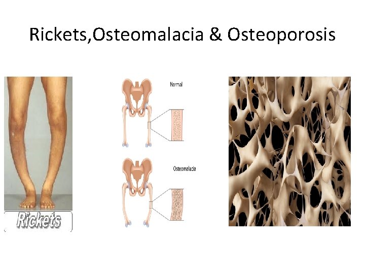 Rickets, Osteomalacia & Osteoporosis Rickets, Osteomalacia & Osteoporosis