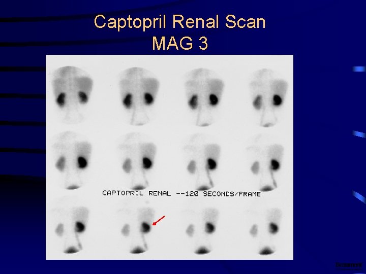 Renal Scintigraphy Materials For Medical Students Helena Balon