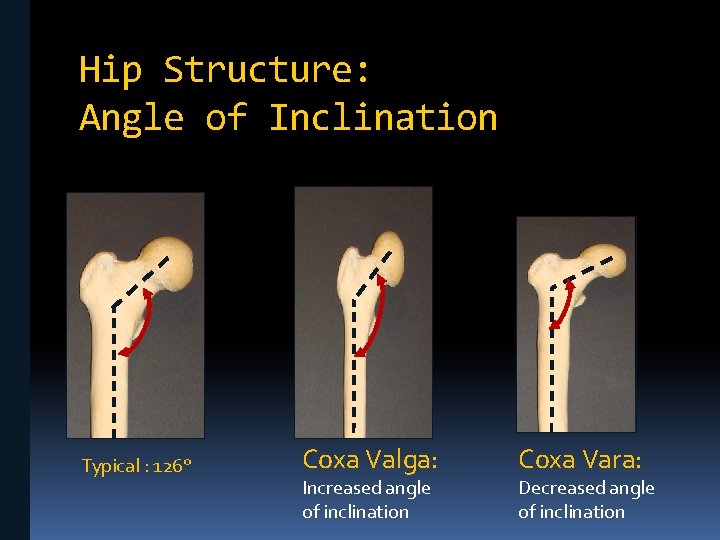 Hip Structure: Angle of Inclination Typical : 126° Coxa Valga: Increased angle of inclination