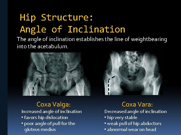 Hip Structure: Angle of Inclination The angle of inclination establishes the line of weightbearing