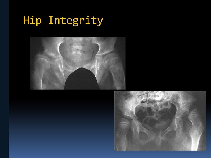 Hip Integrity 