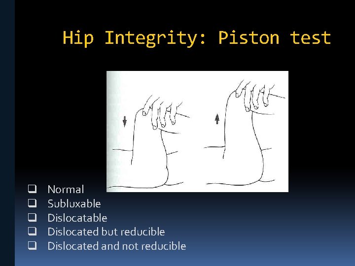 Hip Integrity: Piston test q q q Normal Subluxable Dislocated but reducible Dislocated and