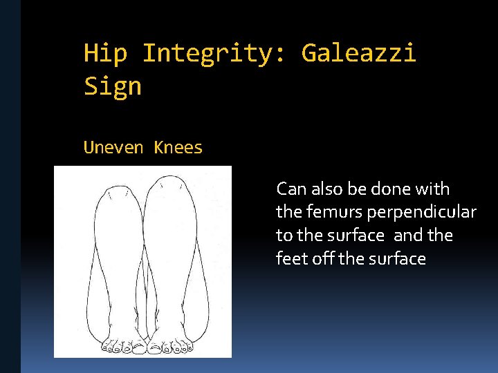 Hip Integrity: Galeazzi Sign Uneven Knees Can also be done with the femurs perpendicular
