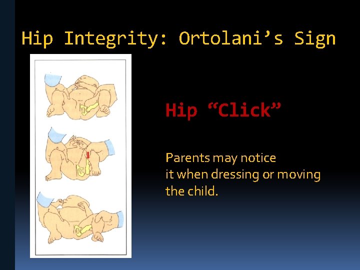Hip Integrity: Ortolani’s Sign Hip “Click” Parents may notice it when dressing or moving