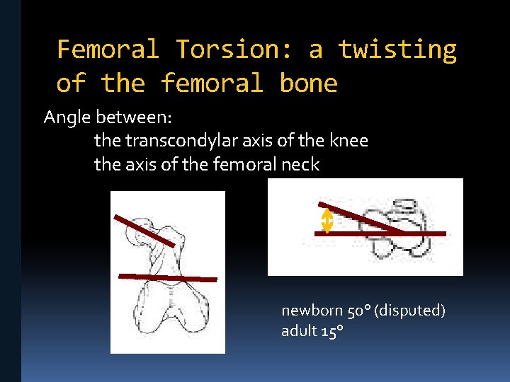 Femoral Torsion: a twisting of the femoral bone Angle between: the transcondylar axis of