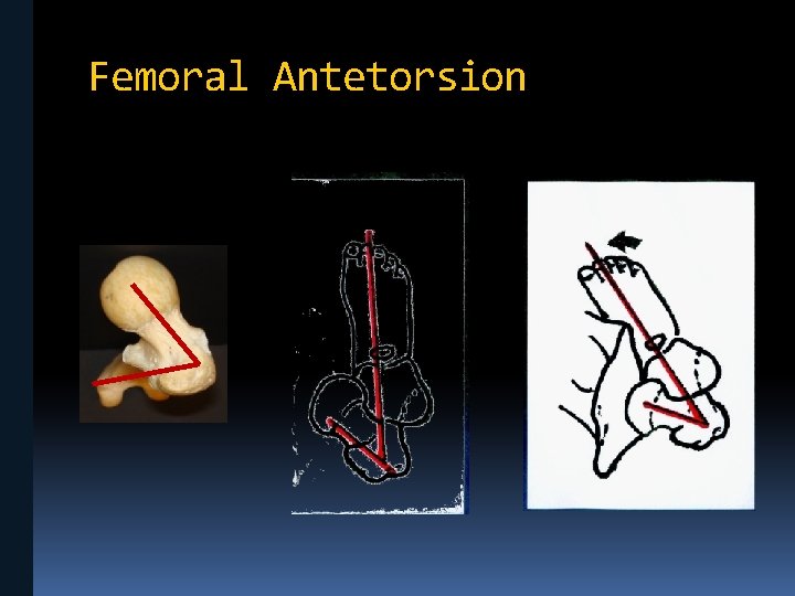 Femoral Antetorsion 