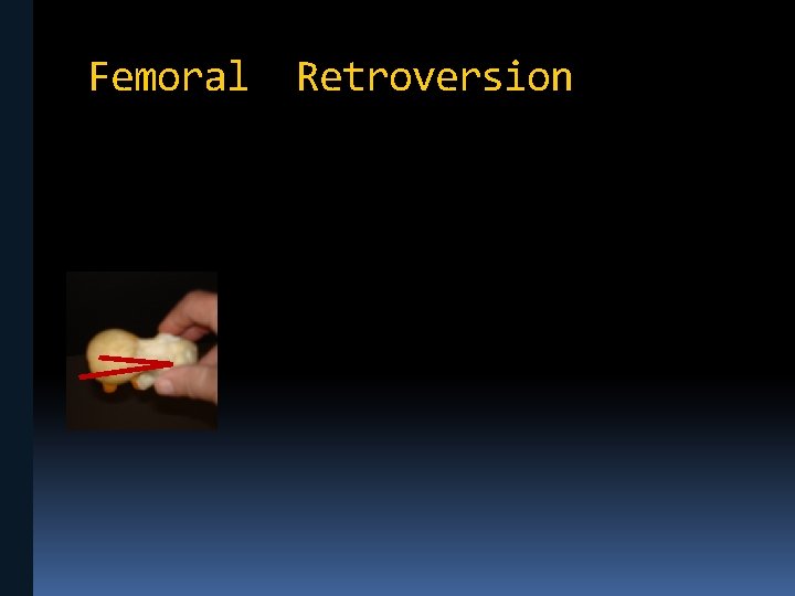 Femoral Retroversion 