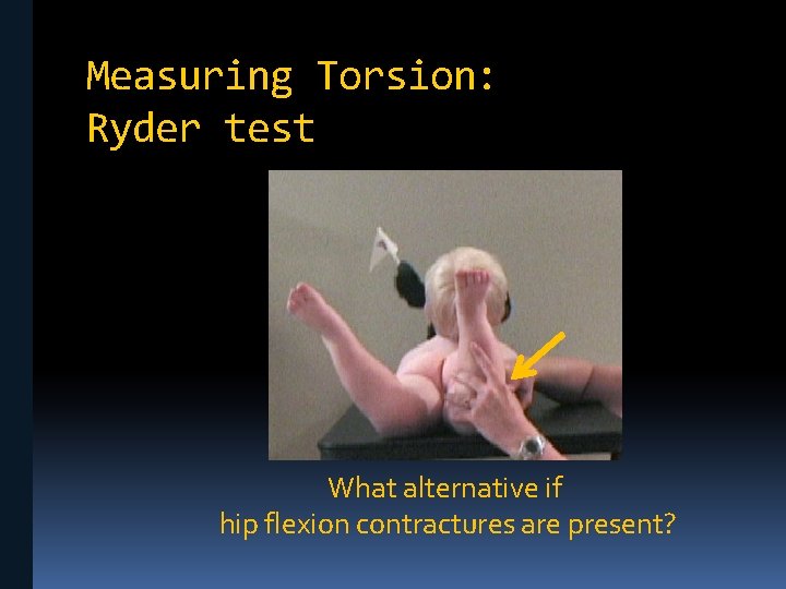 Measuring Torsion: Ryder test What alternative if hip flexion contractures are present? 