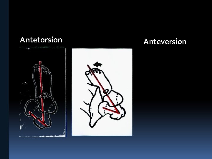 Antetorsion Anteversion 