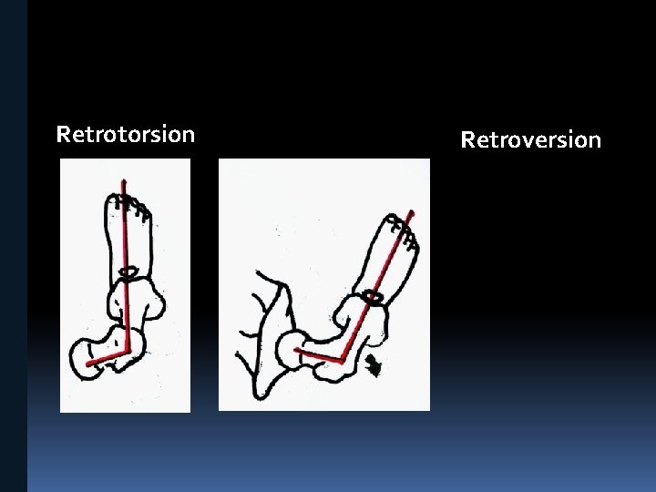 Retrotorsion Retroversion 