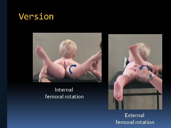 Version Internal femoral rotation External femoral rotation 