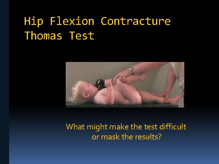 Hip Flexion Contracture Thomas Test What might make the test difficult or mask the