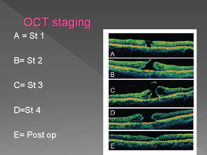 OCT staging A = St 1 B= St 2 C= St 3 D=St 4
