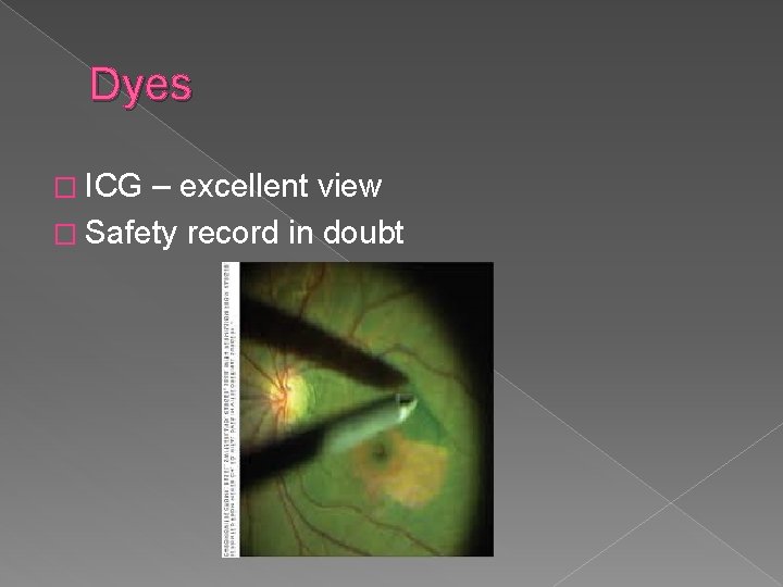 Dyes � ICG – excellent view � Safety record in doubt 