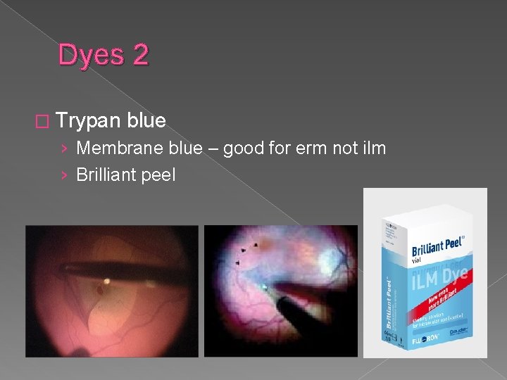 Dyes 2 � Trypan blue › Membrane blue – good for erm not ilm
