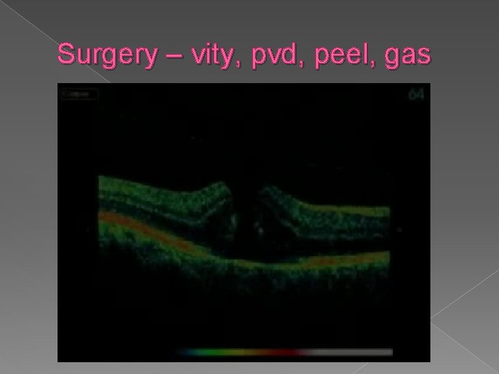 Surgery – vity, pvd, peel, gas 