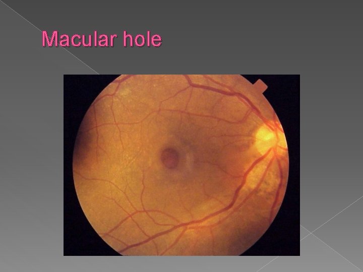 Macular hole 