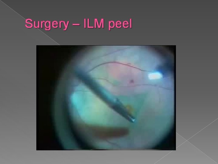 Surgery – ILM peel 