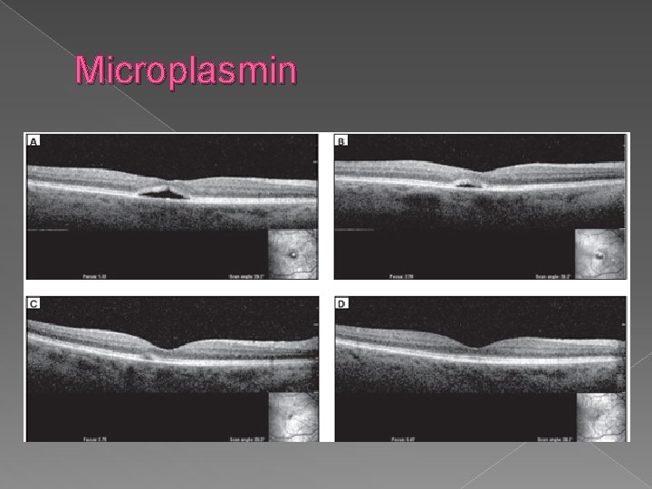 Microplasmin 