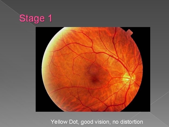 Stage 1 Yellow Dot, good vision, no distortion 